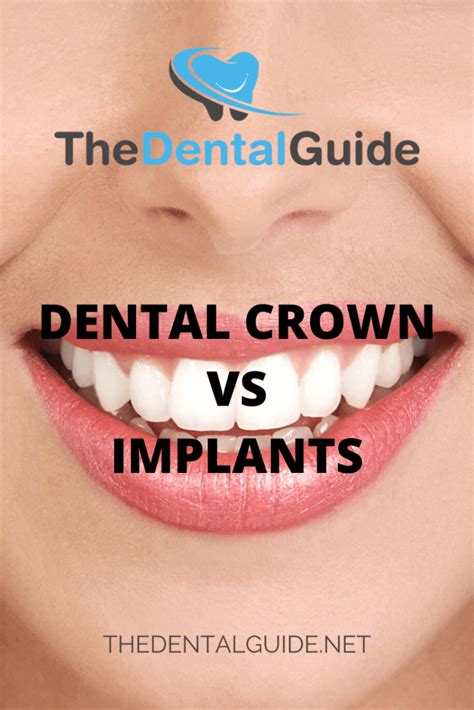 dental crowns - simples dental
